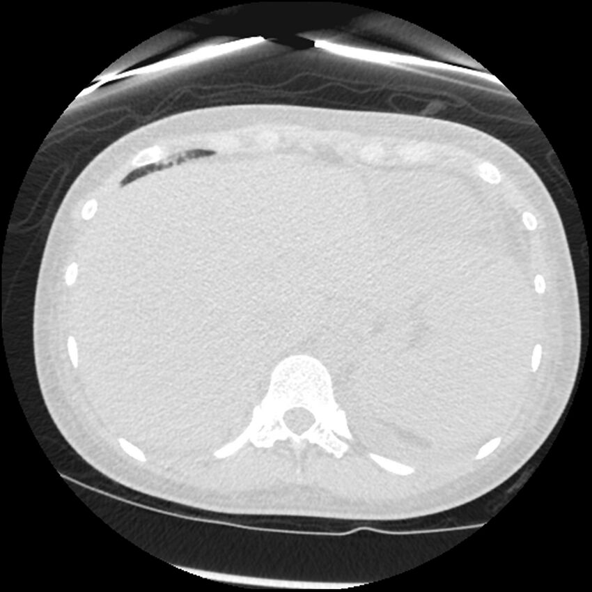 Acute lupus nephritis (Radiopaedia 45832-50107 Axial lung window 88).jpg