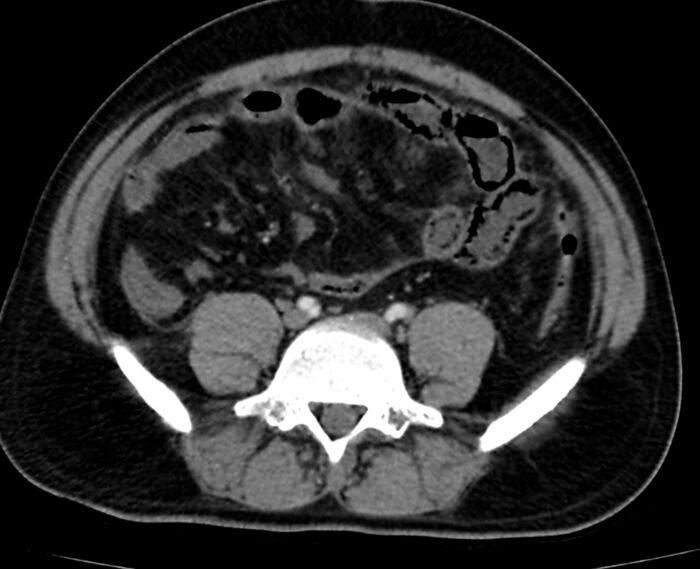 Acute mesenteric ischemia - superior mesenteric artery thrombosis (Radiopaedia 73947-84776 Axial C+ arterial phase 105).jpg