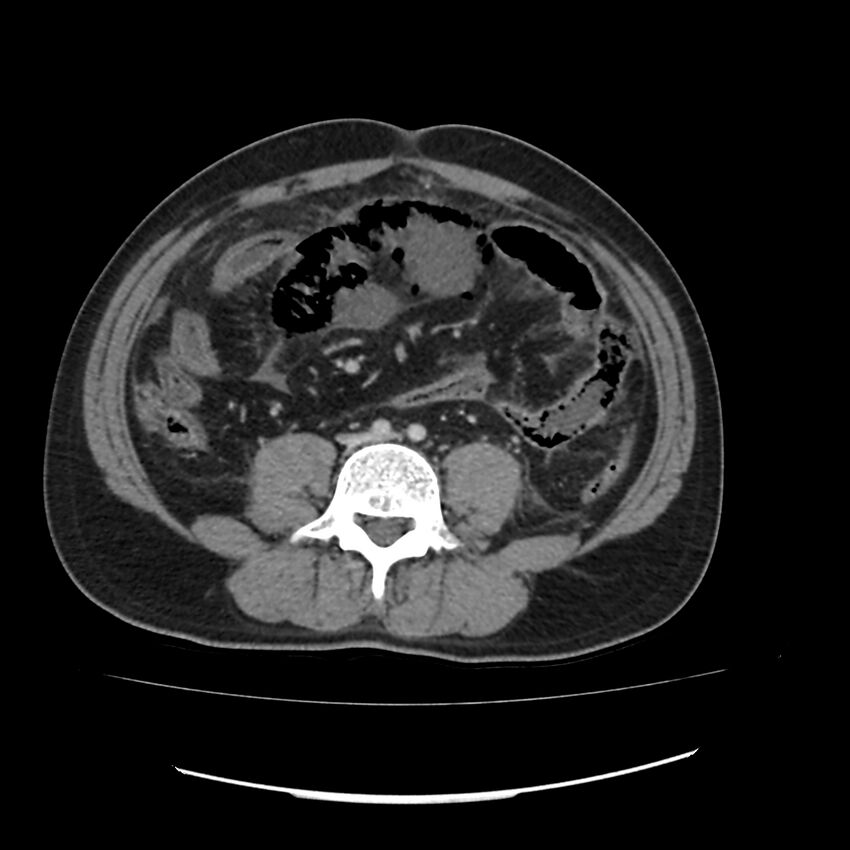 Acute mesenteric ischemia - superior mesenteric artery thrombosis (Radiopaedia 73947-84776 Axial C+ portal venous phase 97).jpg