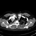 Acute myocardial infarction in CT (Radiopaedia 39947-42415 Axial C+ arterial phase 23).jpg