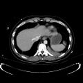 Acute myocardial infarction in CT (Radiopaedia 39947-42415 Axial C+ portal venous phase 18).jpg