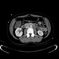 Acute myocardial infarction in CT (Radiopaedia 39947-42415 Axial C+ portal venous phase 60).jpg