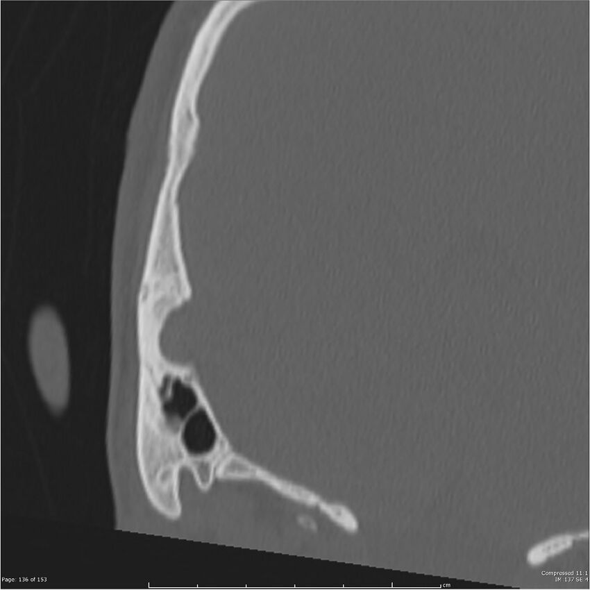 Acute otomastoiditis (Radiopaedia 28276-28512 Coronal PTB bone window reformat 67).jpg