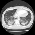Acute pulmonary edema on CT (Radiopaedia 33582-34672 Axial lung window 42).jpg
