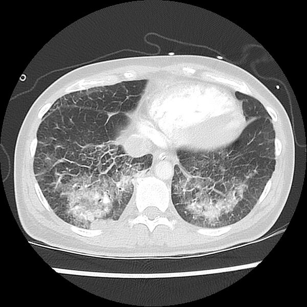 File:Acute pulmonary edema on CT (Radiopaedia 33582-34672 Axial lung window 42).jpg