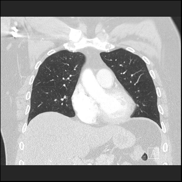 File:Acute pulmonary embolism with pulmonary infarct (Radiopaedia 73062-83768 Coronal lung window 28).jpg