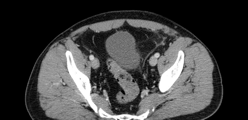 Acute sigmoid colon diverticulitis (Radiopaedia 55507-61976 Axial C+ portal venous phase 95).jpg