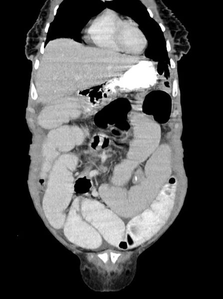 File:Acute small bowel (ileal) volvulus (Radiopaedia 71740-82139 Coronal C+ portal venous phase 29).jpg