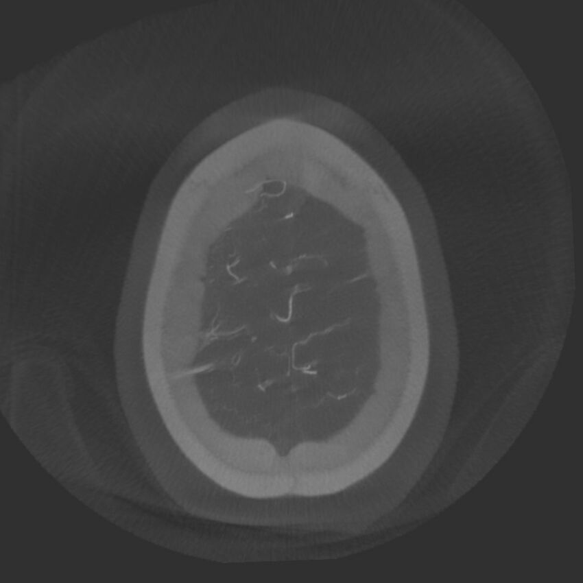 Acute subarachnoid hemorrhage and accessory anterior cerebral artery (Radiopaedia 69231-79010 Axial arterial - MIP 79).jpg