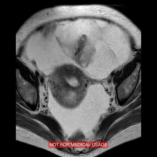 File:Adenocarcinoma of the cervix (Radiopaedia 28373-28615 Axial T2 13).jpg
