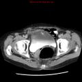 Adenocarcinoma of the colon (Radiopaedia 8191-9039 Axial renal excretory phase 56).jpg