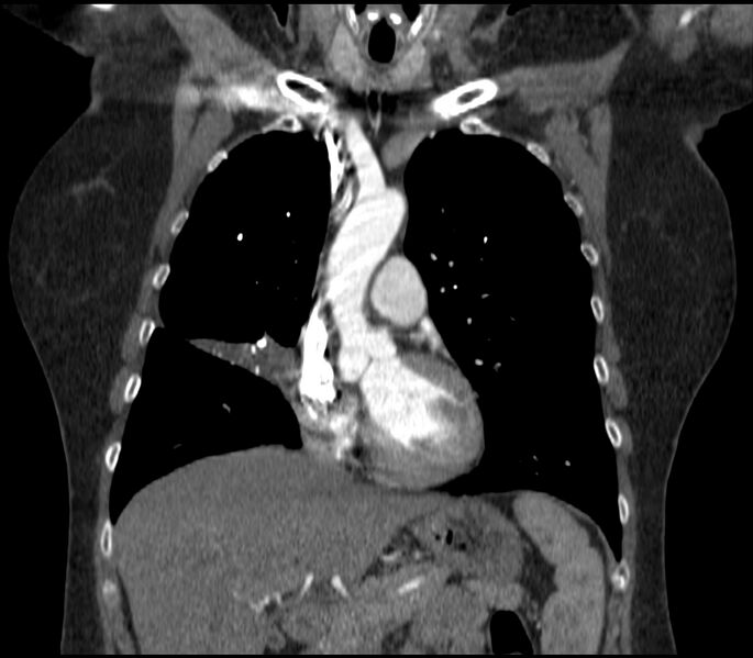 File:Adenocarcinoma of the lung (Radiopaedia 44205-47803 Coronal C+ portal venous phase 33).jpg