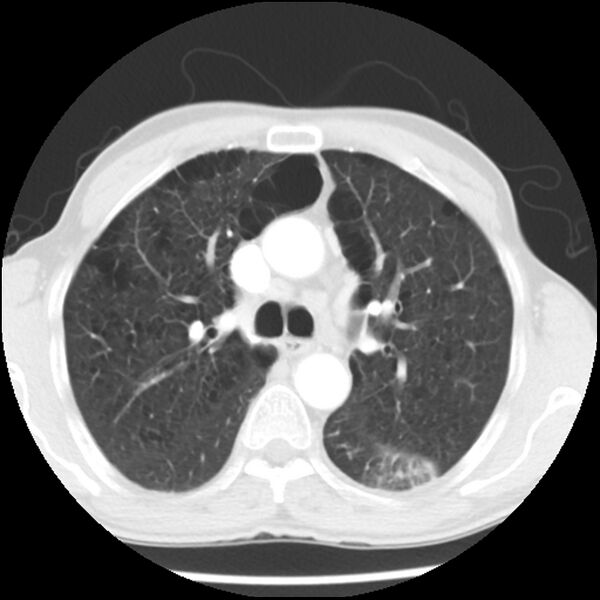 File:Adenocarcinoma of the lung - micropapillary predominant (Radiopaedia 42446-45563 Axial lung window 26).jpg