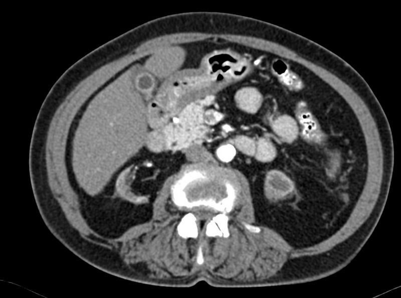 File:Adenomyomatosis of the gallbladder (Radiopaedia 12142-12483 Axial C+ arterial phase 16).jpg
