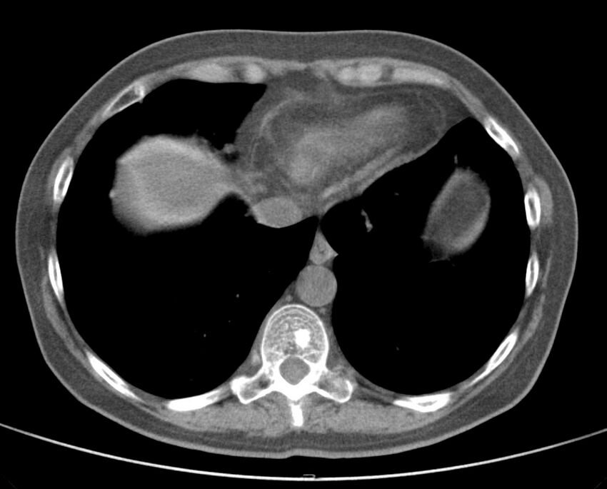 Adenosquamous lung carcinoma (Radiopaedia 22035-22030 non-contrast 47).jpg