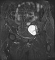 Adnexal multilocular cyst (O-RADS US 3- O-RADS MRI 3) (Radiopaedia 87426-103754 Coronal T2 fat sat 11).jpg