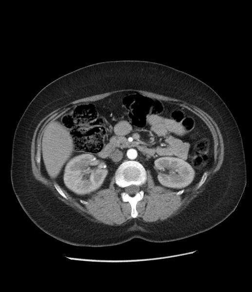 File:Adrenal cortical carcinoma with IVC invasion and thrombosis (Radiopaedia 34307-35597 Axial C+ arterial phase 38).jpg