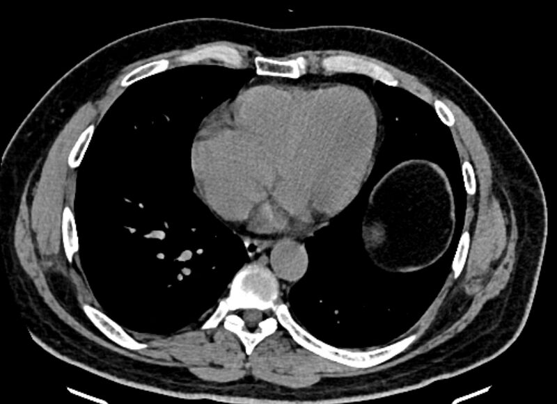 File:Adrenal metastases (Radiopaedia 73082-83791 Axial non-contrast 2).jpg