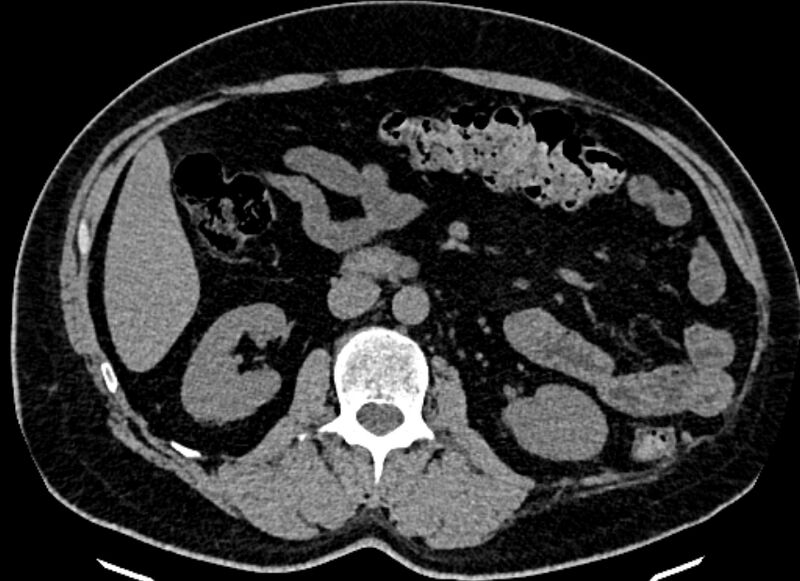 File:Adrenal metastases (Radiopaedia 73082-83791 Axial non-contrast 85).jpg