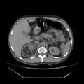 Adrenal myelolipoma (Radiopaedia 41843-44834 Axial non-contrast 22).jpg