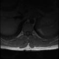 Aggressive vertebral hemangioma (Radiopaedia 39937-42404 Axial T1 12).png