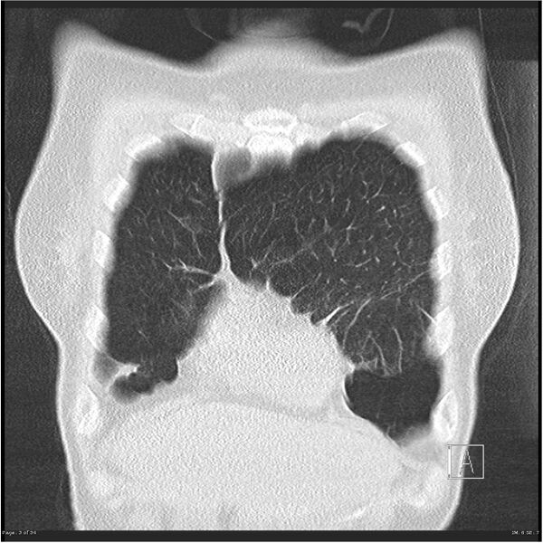 File:Alpha-1-antitrypsin deficiency (Radiopaedia 26537-26678 Coronal lung window 3).jpg