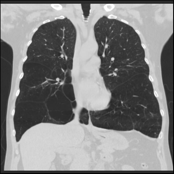 File:Alpha-1-antitrypsin deficiency (Radiopaedia 40993-43722 Coronal lung window 44).jpg