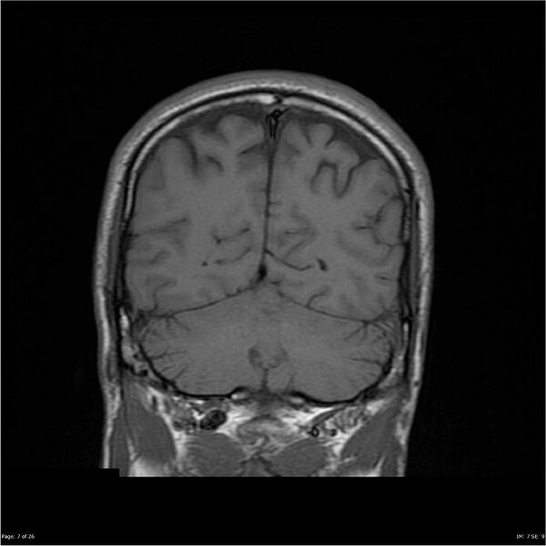File:Amnestic syndrome secondary to hypoxic brain injury (Radiopaedia 24743-25004 B 7).jpg