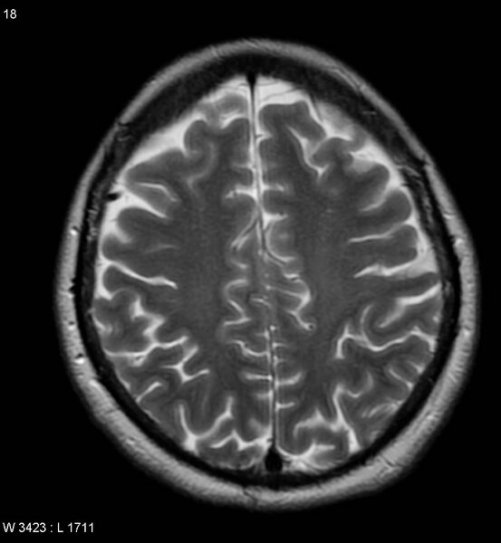File:Amyotrophic lateral sclerosis (Radiopaedia 5373-7134 Axial T2 18).jpg