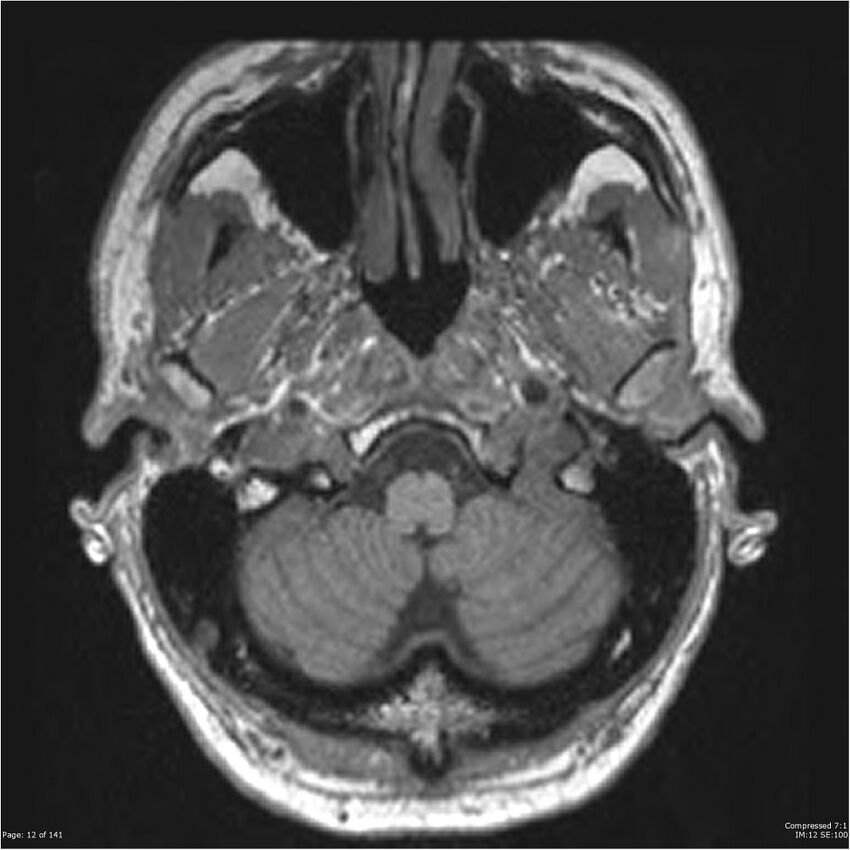 Anaplastic meningioma with recurrence (Radiopaedia 34452-35788 Axial T1 10).jpg