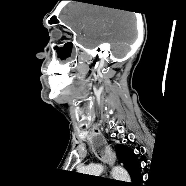 File:Anaplastic thyroid carcinoma (Radiopaedia 79087-92034 C 62).jpg