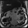 Annular pancreas (Radiopaedia 38292-40320 Coronal T2 25).png