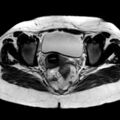 Ano-vaginal fistula (Radiopaedia 29765-30284 Axial T2 16).jpg