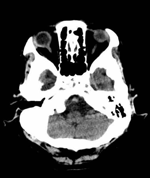 File:Anomalous intracranial venous drainage (Radiopaedia 28161-28418 Axial 51).png