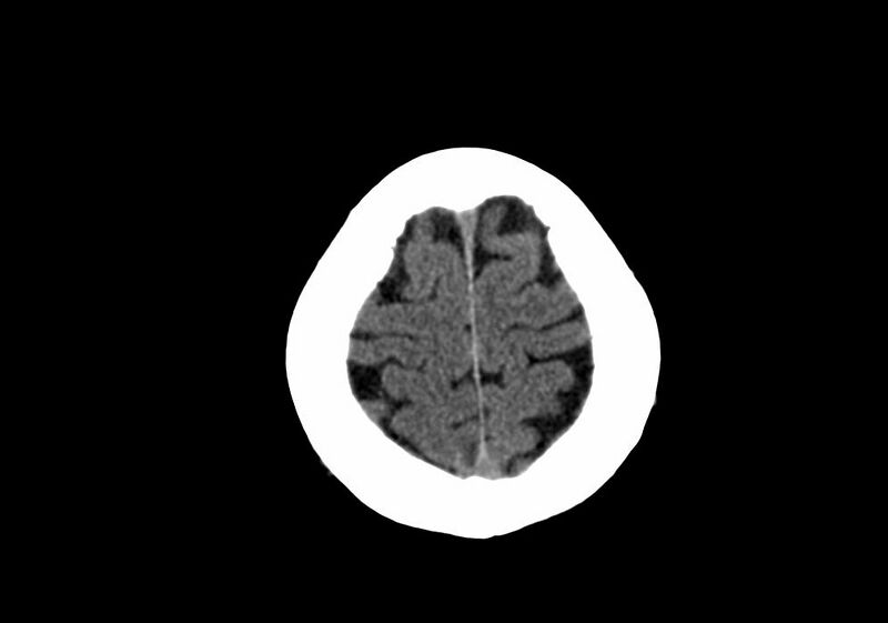 File:Anomalous intracranial venous drainage (Radiopaedia 28161-28418 Axial non-contrast 40).jpg