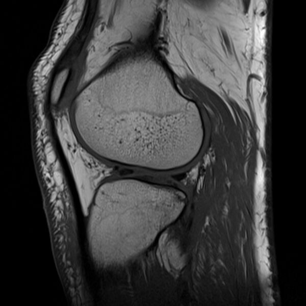 File:Anterior cruciate ligament tear - ramp lesion (Radiopaedia 71883-82322 Sagittal T1 8).jpg