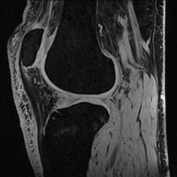 File:Anterior cruciate ligament tear - ramp lesion (Radiopaedia 71883-82322 Sagittal T1 vibe 56).jpg