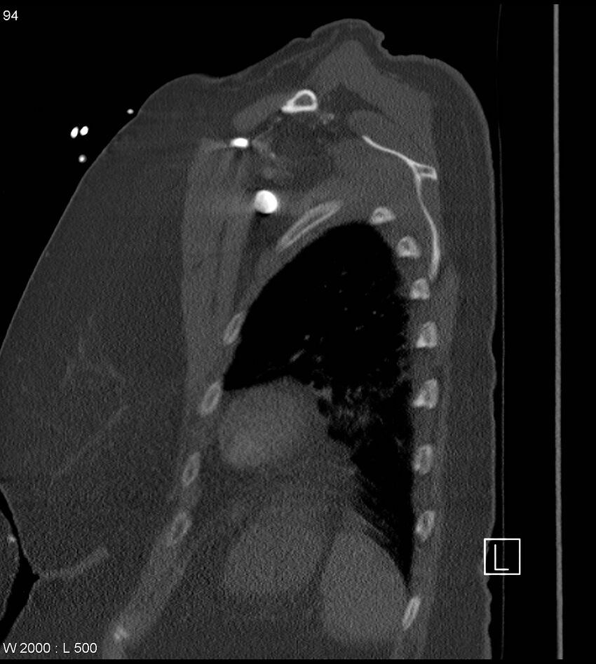 Anterior shoulder dislocation (CT) (Radiopaedia 59032-66309 Sagittal bone window 47).jpg