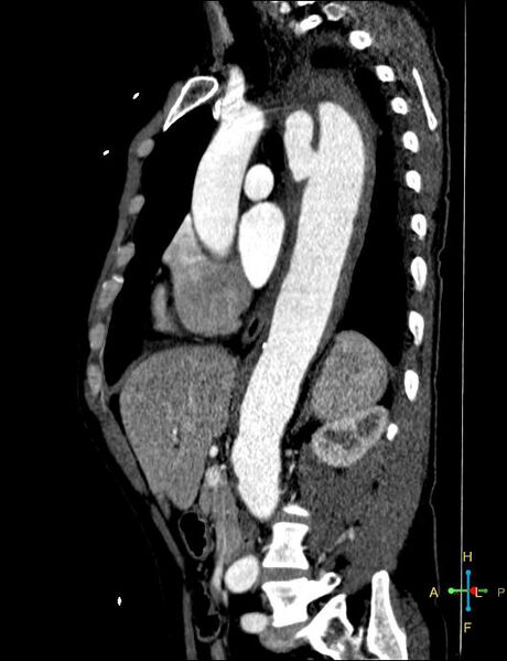 File:Aortic aneurysm and penetrating ulcer (Radiopaedia 23590-23704 C 19).jpg