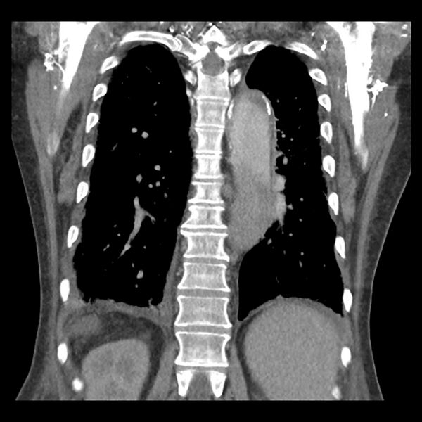 File:Aortic arch graft infection (FDG PET-CT) (Radiopaedia 71975-82437 Coronal 45).jpg