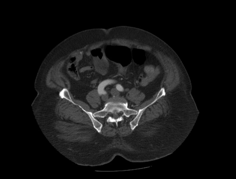 File:Aortic dissection (Radiopaedia 28802-29105 A 82).jpg