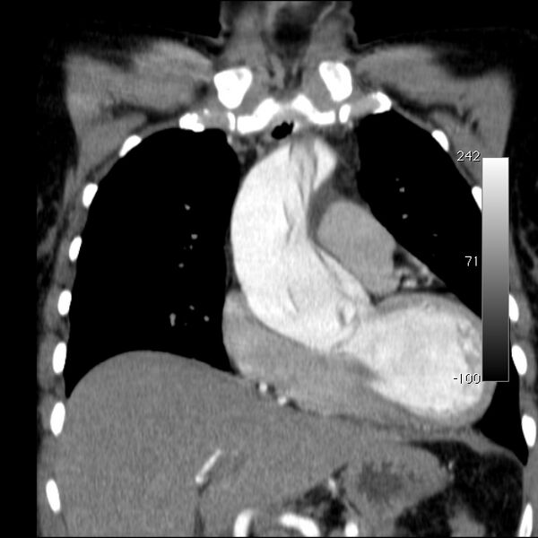 File:Aortic dissection - Stanford type A (Radiopaedia 29247-29659 B 22).jpg