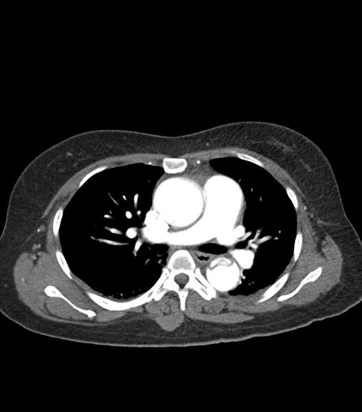 File:Aortic dissection with renal ischemia (Radiopaedia 76573-88338 A 26).jpg
