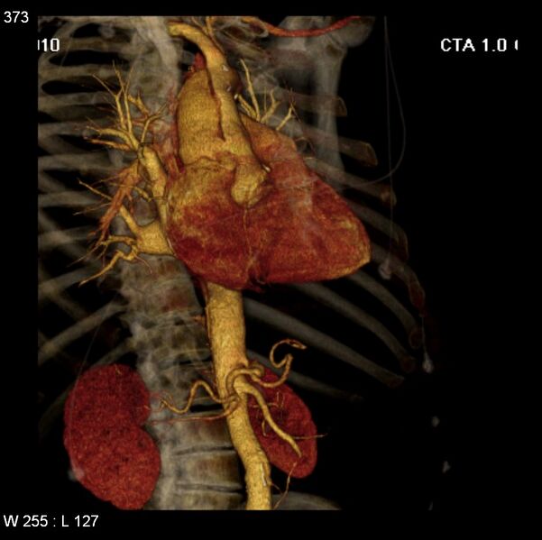 File:Aortic dissection with rupture into pericardium (Radiopaedia 12384-12647 C+ arterial phase 5).jpg