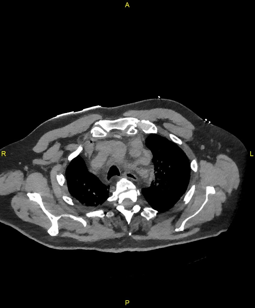 Aortic rupture (Radiopaedia 88822-105594 Axial non-contrast 35).jpg