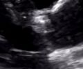 Aortic stenosis (transthoracic echocardiography) (Radiopaedia 63358-71946 E 1).jpg