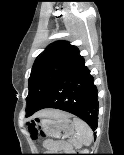 File:Aortic valve non-coronary cusp thrombus (Radiopaedia 55661-62189 D 10).png