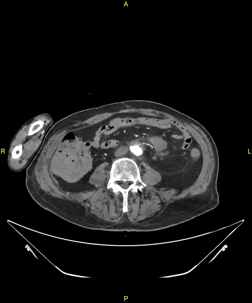 Aortoenteric fistula (Radiopaedia 84308-99603 B 220).jpg