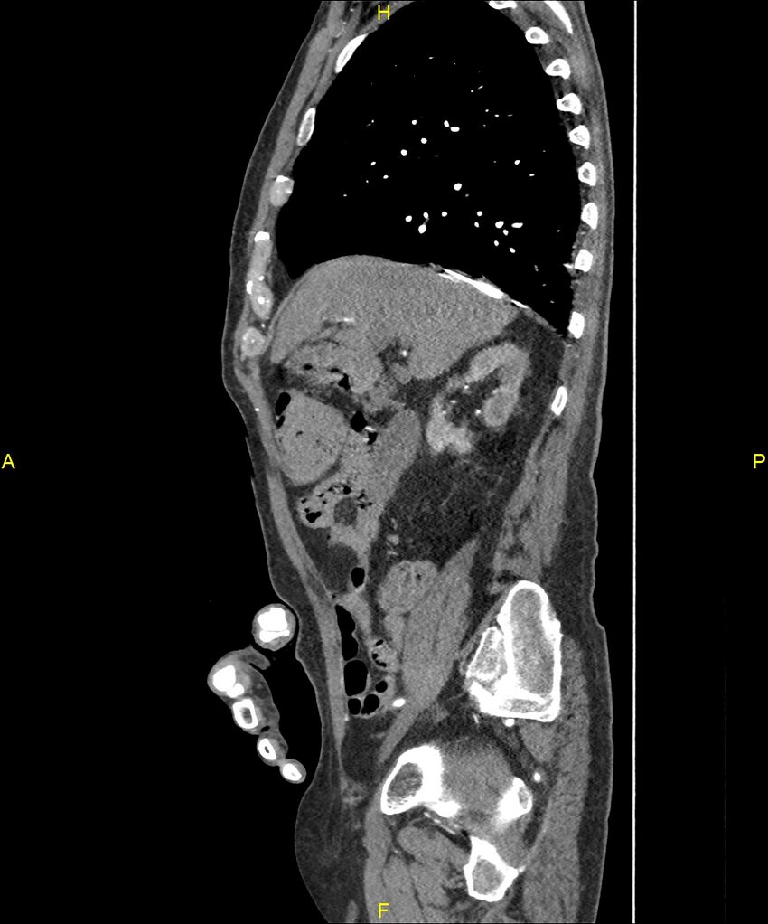Aortoenteric fistula (Radiopaedia 84308-99603 C 113).jpg
