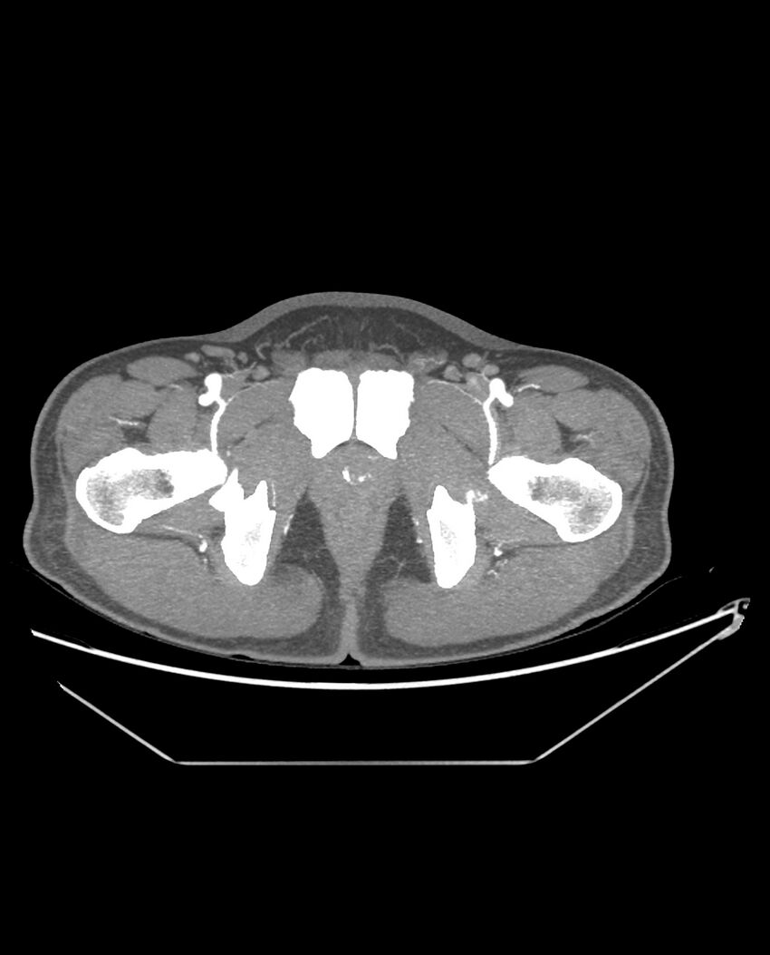 Aplastic posterior tibial arteries (Radiopaedia 84021-99249 A 104).jpg
